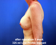 plastic-surgery-breast-augmentation